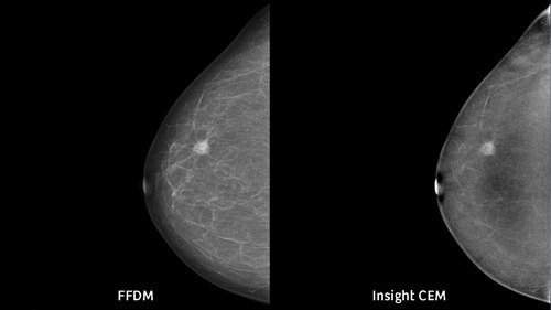 Siemens Mammomat Digital Mammography System - Image 3