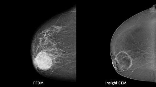 Siemens Mammomat Digital Mammography System - Image 2