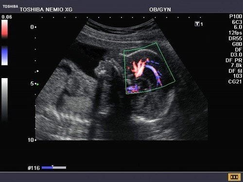 Toshiba Nemio XG Ultrasound Machine - Image 3
