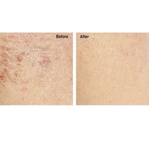 Before and after results showing smoother, more hydrated skin